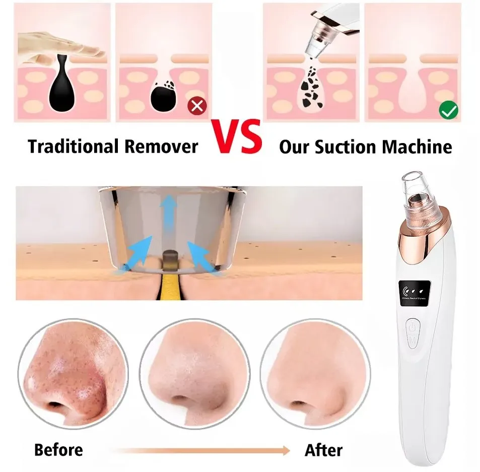 5-in-1 Rechargeable Blackhead Remover Vacuum with 5 Suction Heads 3 5-in-1 Rechargeable Blackhead Remover Vacuum with 5 Suction Heads - Image 3